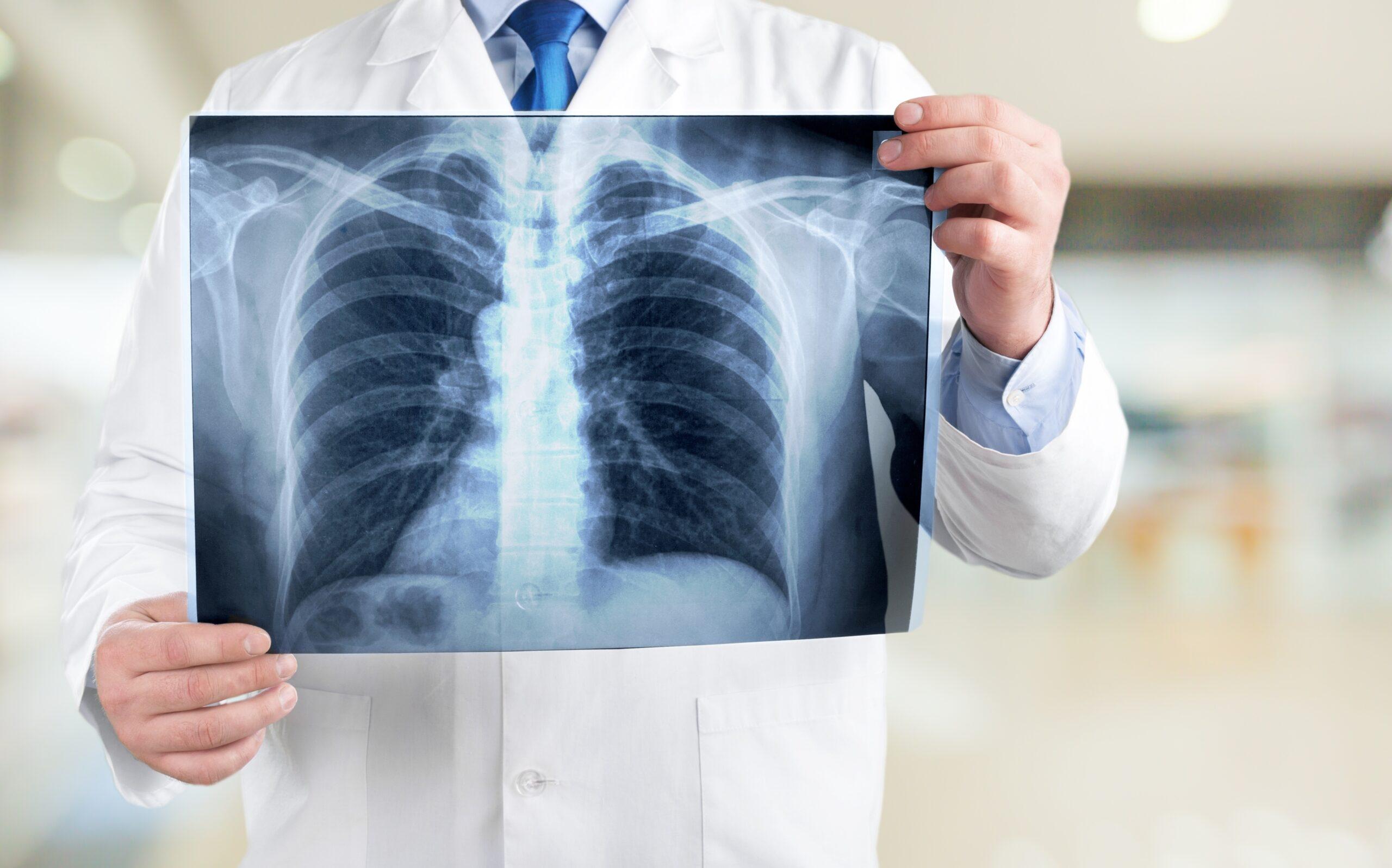 Czy guzki na płucach są groźne? Co oznaczają i jak się je leczy?